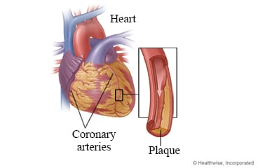 Coronary arteries and plaque in arteries.