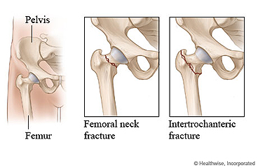 A hip and two types of hip fractures