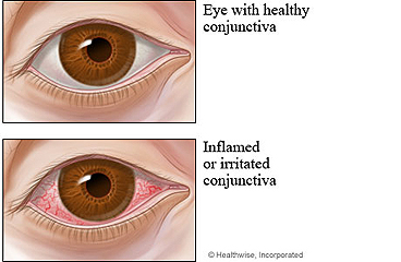 Picture of a healthy eye and an eye with pinkeye