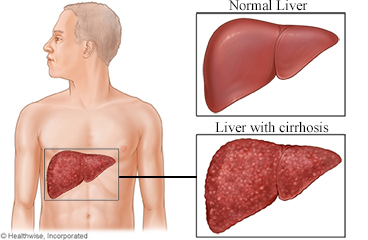 Normal liver and a liver with cirrhosis