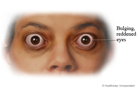 Bulging eyes caused by thyroid disease