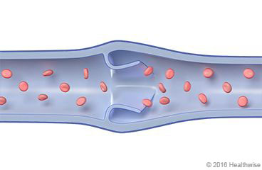 Blood cells flowing through a blood vessel