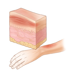 Picture of a burn on the arm