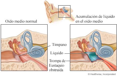 Oído medio normal y acumulación de líquido en el oído medio Oído medio normal y acumulación de líquido en el oído medio