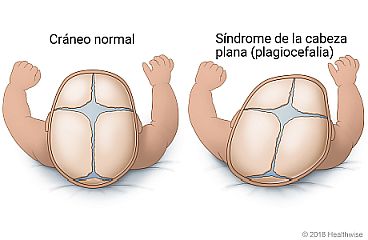 Vista lado a lado de cráneo de lactante normal y cráneo de lactante con aplanamiento en un lado.