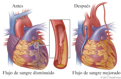 Flujo de sangre reducido a causa de una arteria estrechada u obstruida antes de la cirugía y flujo de sangre mejorado después de la cirugía Flujo de sangre reducido a causa de una arteria estrechada u obstruida antes de la cirugía y flujo de sangre mejorado después de la cirugía