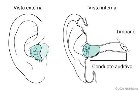Vista externa e interna de audífono intracanal colocado en el oído. Vista externa e interna de audífono intracanal colocado en el oído.