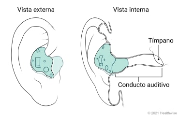 Vista externa e interna de un audífono endoaural colocado en el oído. Vista externa e interna de un audífono endoaural colocado en el oído.