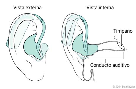 Vista externa e interna de audífono retroauricular colocado en la oreja. Vista externa e interna de audífono retroauricular colocado en la oreja.