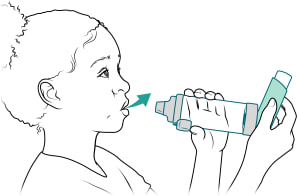 El niño sujeta el inhalador y la cámara de inhalación mientras exhala. El niño sujeta el inhalador y la cámara de inhalación mientras exhala.