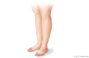 Lugares en las piernas y los pies donde son comunes los salpullidos Lugares en las piernas y los pies donde son comunes los salpullidos