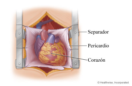 Separador que deja expuesto el corazón en el pecho Separador que deja expuesto el corazón en el pecho