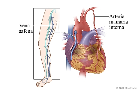 Ubicación de la vena safena en la pierna, y el corazón que muestra la vena safena y una arteria mamaria interna utilizada para sortear la arteria coronaria enferma Ubicación de la vena safena en la pierna, y el corazón que muestra la vena safena y una arteria mamaria interna utilizada para sortear la arteria coronaria enferma