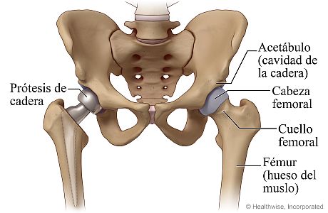 Cadera normal y artroplastia parcial de cadera