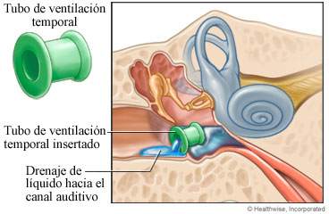 Tubo de ventilación colocado en el oído y líquido que drena en el conducto auditivo Tubo de ventilación colocado en el oído y líquido que drena en el conducto auditivo