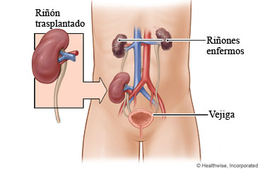 Riñones enfermos y riñón trasplantado
