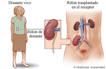 Un donante vivo y un trasplante de riñón