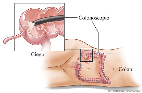 Colonoscopio en el colon Colonoscopio en el colon