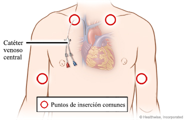 Colocación de antibióticos en un catéter