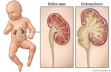 Imagen de un niño con un primer plano de un riñón sano y un riñón con hidronefrosis