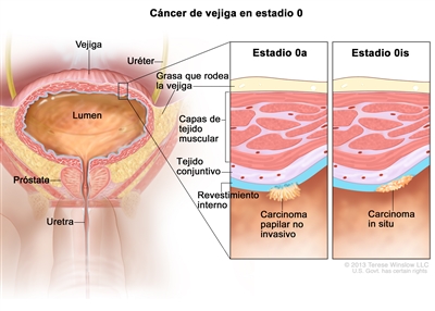 Cáncer de vejiga en estadio 0 (cáncer de vejiga no invasivo). En la imagen se muestran la vejiga, el lumen de la vejiga (espacio donde se almacena la orina), los uréteres, la próstata y la uretra. En una ampliación con dos recuadros se observa un cáncer en estadio 0a (también llamado carcinoma papilar no invasivo) en el revestimiento interno de la vejiga y un cáncer en estadio 0is (también llamado carcinoma in situ) en el revestimiento interno de la vejiga. También se señalan el tejido conjuntivo y las capas de tejido muscular de la vejiga, así como la grasa que la rodea.