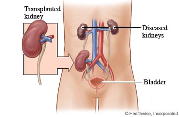 A healthy donor kidney transplanted into a person with diseased kidneys.