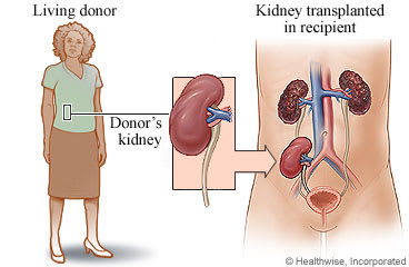 Kidney transplant.