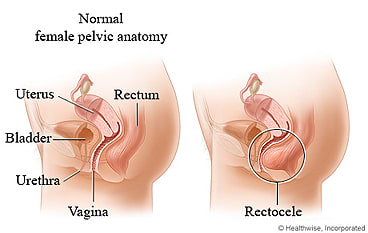 Picture of normal female anatomy and rectocele.