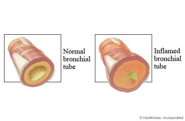 Normal and inflamed airways.