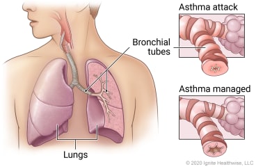 Lungs in chest showing bronchial tubes in left lung, with detail of bronchial tube affected by asthma attack compared to one with managed asthma.