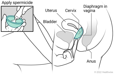 Female pelvic organs, showing uterus, cervix, bladder, and anus, with spermicide put in diaphragm and placed in vagina at cervix.