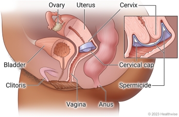 Detail of placement of cervical cap with spermicide on cervix, with locations of vagina, clitoris, ovary, uterus, cervix, bladder, and anus.