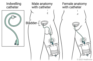 Indwelling catheter, showing it inserted in male anatomy and female anatomy to drain urine from bladder into collection bag strapped to leg.