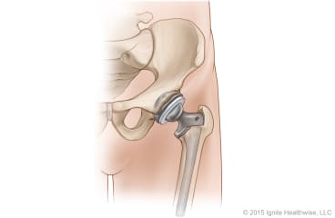 Completed hip replacement.