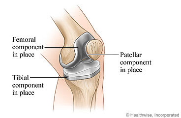Knee structure after total knee replacement.