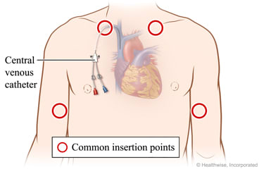 Areas on upper arms and upper chest where device may be put in.