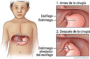 Ubicación del esófago y el estómago, con detalle de su aspecto antes y después de la cirugía.