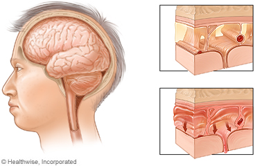 El cerebro normal e inflamado