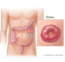 A colostomy stoma.