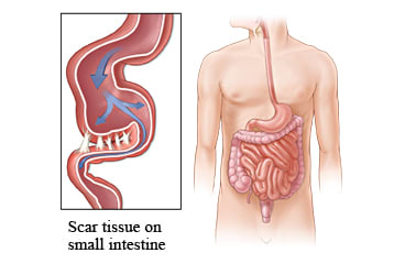 Adhesions on the small intestine.