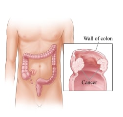 Cancer in the colon