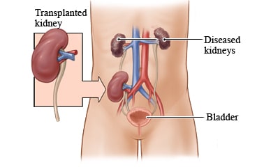 Diseased kidneys and transplanted kidney.