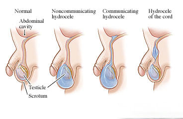 Normal testicle and testicles with hydroceles.