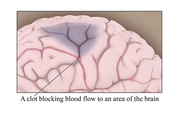 A clot blocking blood flow to an area of the brain.