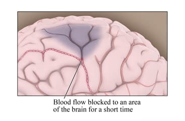 Blood flow blocked to an area of the brain for a short time.