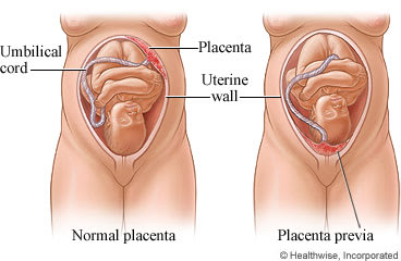 Developing baby with normal placenta attached to uterine wall and developing baby with placenta previa, where placenta blocks uterus opening.