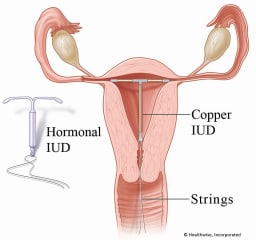 An IUD in the uterus