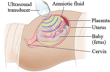 Fetal ultrasound using an ultrasound transducer and showing the uterus, placenta, amniotic fluid, fetus, and cervix.