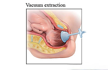 Vacuum extraction.