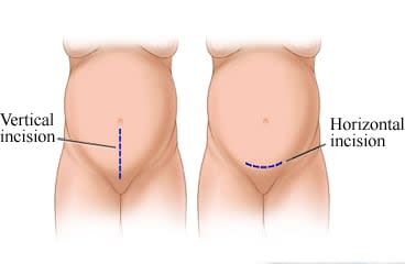 Cesarean incisions, both vertical and horizontal